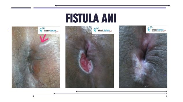 images fistula ani -8