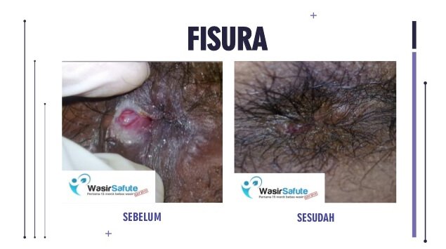 images fisula ani -2
