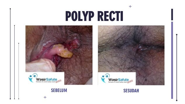 images fisula ani -3