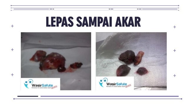 images fisula ani -4