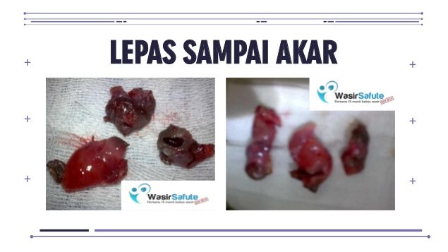 images fisula ani -5