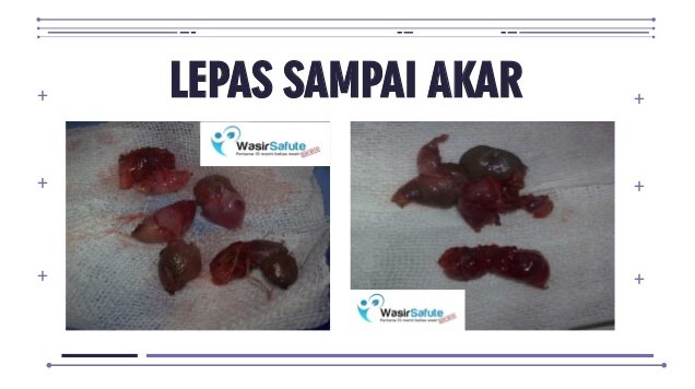 images fisula ani -6