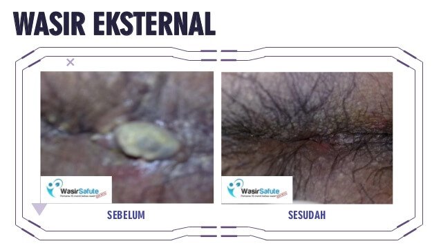 img-sebelum-sesudah-klinikwasirfistula-1