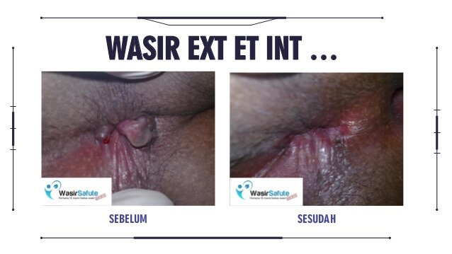 img-sebelum-sesudah-klinikwasirfistula-4