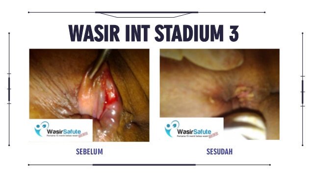 img-sebelum-sesudah-klinikwasirfistula-6