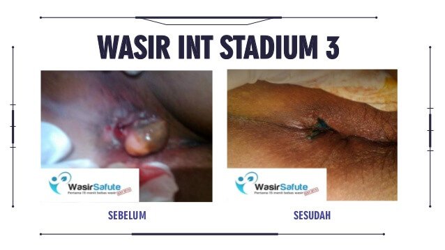 img-sebelum-sesudah-klinikwasirfistula-7