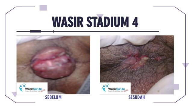 img-sebelum-sesudah-klinikwasirfistula-8